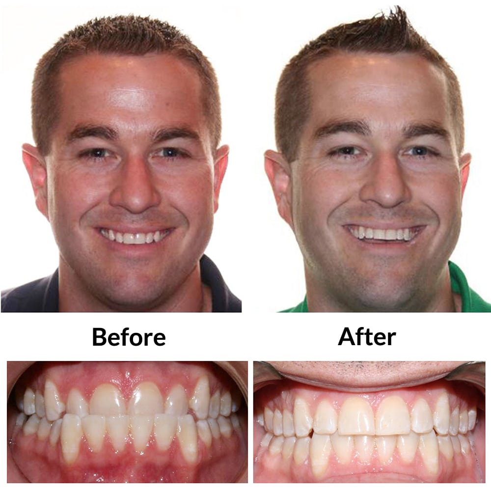 Invisalign Before and After Photo 2