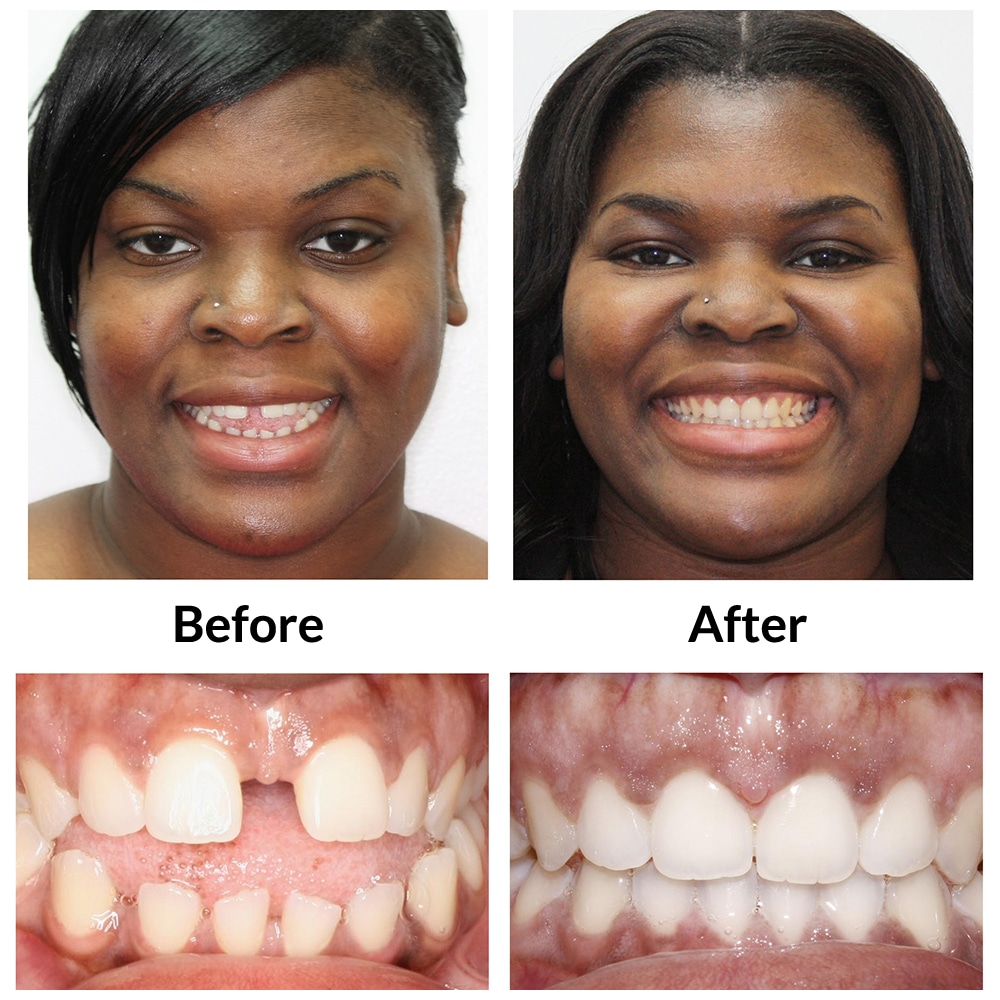 Invisalign Before and After Photo 1