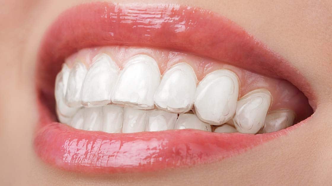 Photo of Clear Aligners