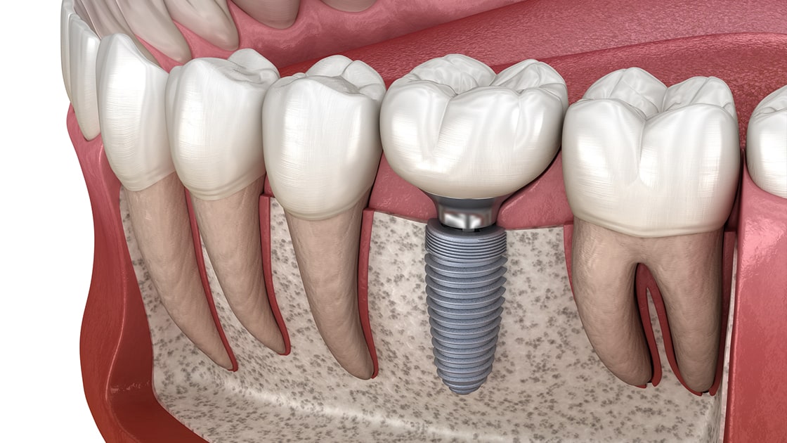 Dental Implants decorative image
