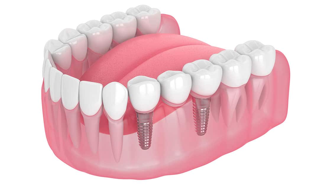 Implant Supported Bridge Photo