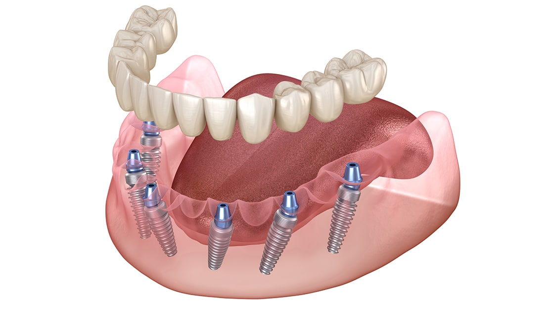 Implant Supported Dentures Photo